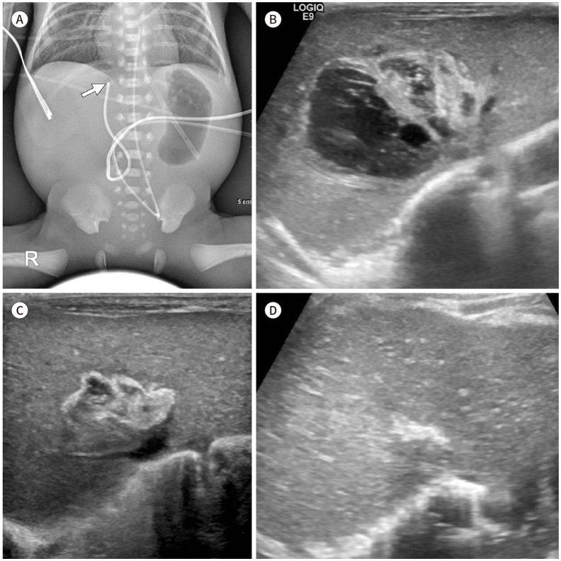 Imaging of Umbilical Venous Catheter-Related Hepatic Complications in Neonates.