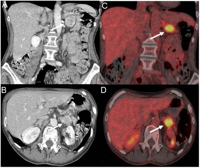 Catastrophic ACTH-secreting pheochromocytoma: an uncommon and challenging entity with multifaceted presentation.