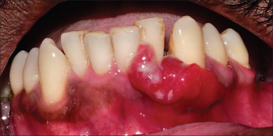 Fibrosarcoma of the gingiva: A rare entity.