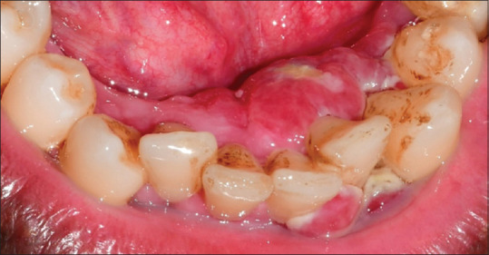 Fibrosarcoma of the gingiva: A rare entity.