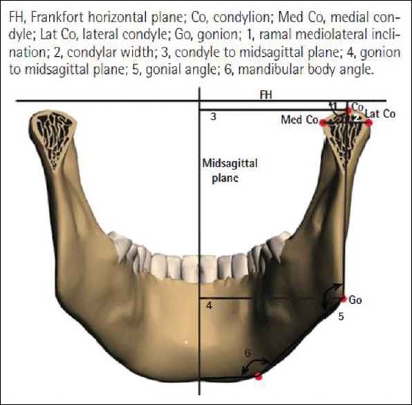 CT-based retrospective cohort study for the evaluation of mandibular condylar dimensions - A pilot study.