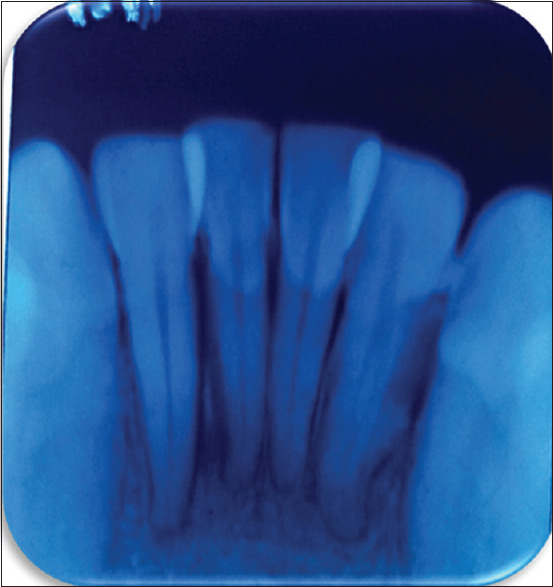 Fibrosarcoma of the gingiva: A rare entity.