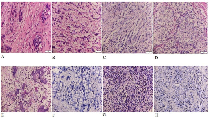 Clinicopathological Features of Invasive Breast Cancer: A Five-Year Retrospective Study in Southern and South-Western Ethiopia.