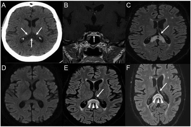 Catastrophic ACTH-secreting pheochromocytoma: an uncommon and challenging entity with multifaceted presentation.