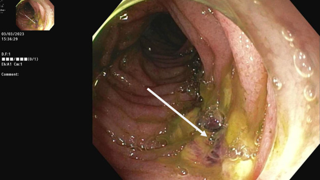 A Rare Case of Anterograde Gastroduodenal Intussusception Caused by Migrated Percutaneous Endoscopic Gastrostomy Feeding Tube.