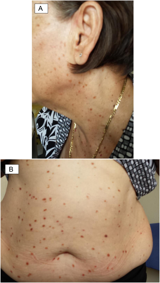 Skin and bones: systemic mastocytosis and bone.