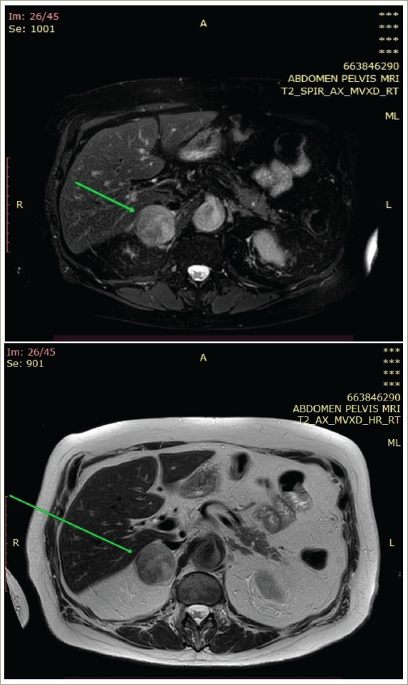 Surgical Treatment of Solitary Metachronous Adrenal Metastasis from Urothelial Carcinoma of the Urinary Bladder.