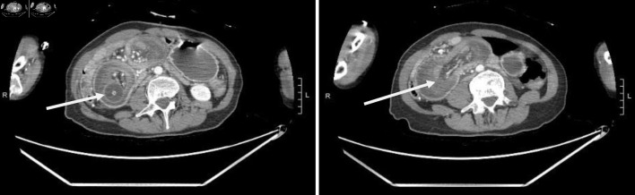 A Rare Case of Anterograde Gastroduodenal Intussusception Caused by Migrated Percutaneous Endoscopic Gastrostomy Feeding Tube.