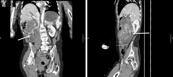 A Rare Case of Anterograde Gastroduodenal Intussusception Caused by Migrated Percutaneous Endoscopic Gastrostomy Feeding Tube.