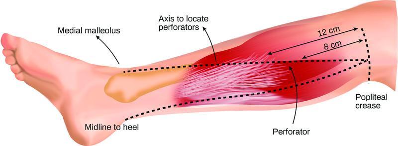 The Medial Sural Artery Perforator Flap versus Other Free Flaps in Head and Neck Reconstruction: A Systematic Review.