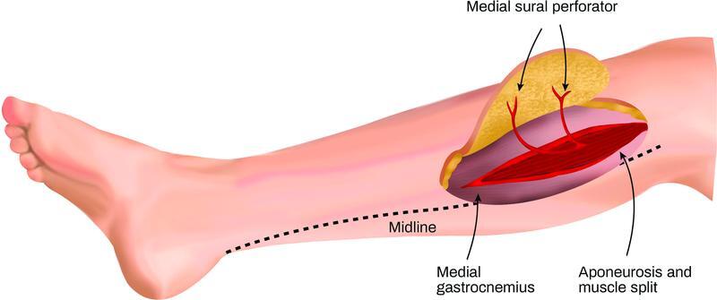 The Medial Sural Artery Perforator Flap versus Other Free Flaps in Head and Neck Reconstruction: A Systematic Review.