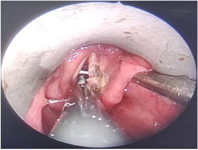 Idiopathic bilateral abductor cord palsy-can it be the cause of obstructive sleep apnea?