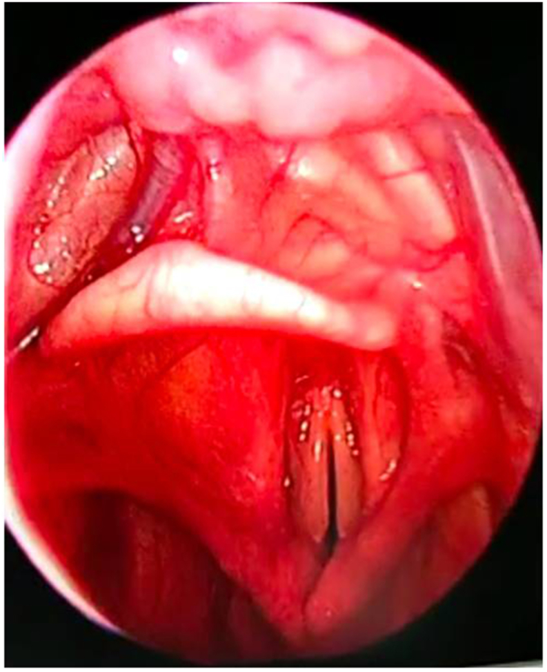 Idiopathic bilateral abductor cord palsy-can it be the cause of obstructive sleep apnea?