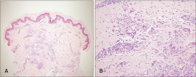 Simultaneous Improvement of Cutaneous Sarcoidosis and Psoriasis Vulgaris on Administration of a Tumor Necrosis Factor Alpha Inhibitor.