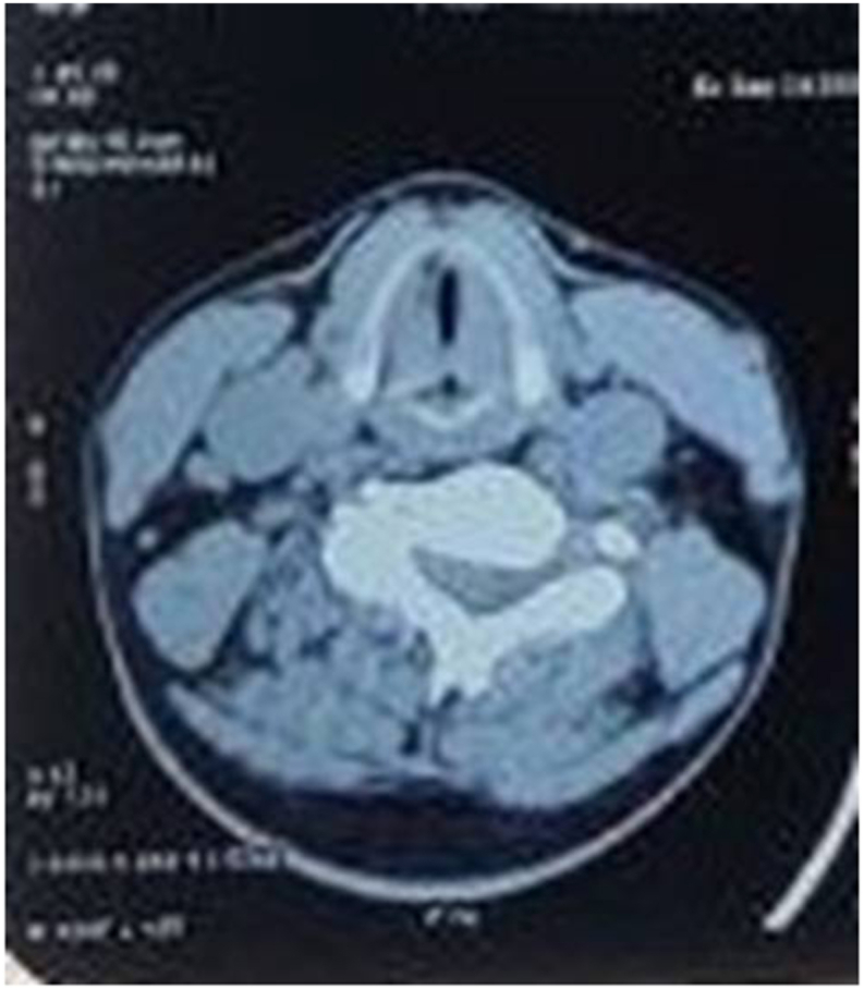 Idiopathic bilateral abductor cord palsy-can it be the cause of obstructive sleep apnea?