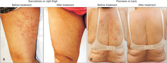 Simultaneous Improvement of Cutaneous Sarcoidosis and Psoriasis Vulgaris on Administration of a Tumor Necrosis Factor Alpha Inhibitor.