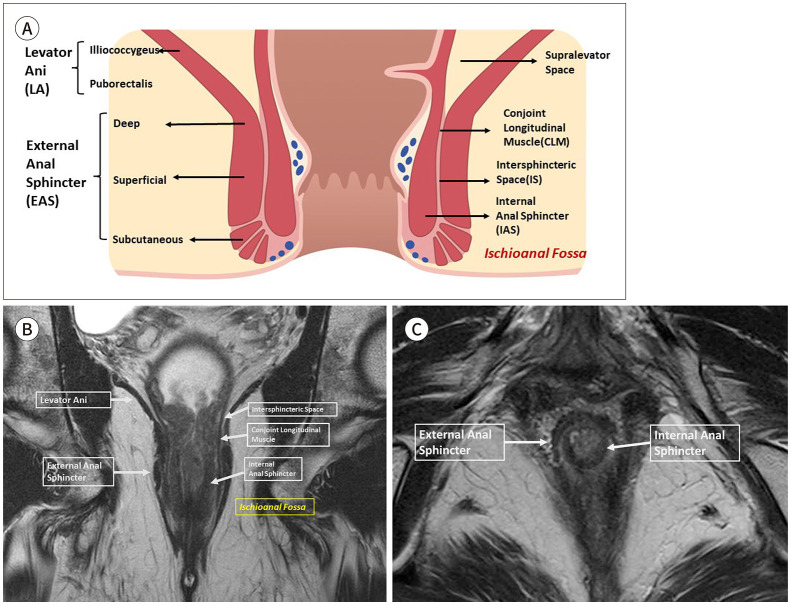 [Perianal Fistula: An Overview].