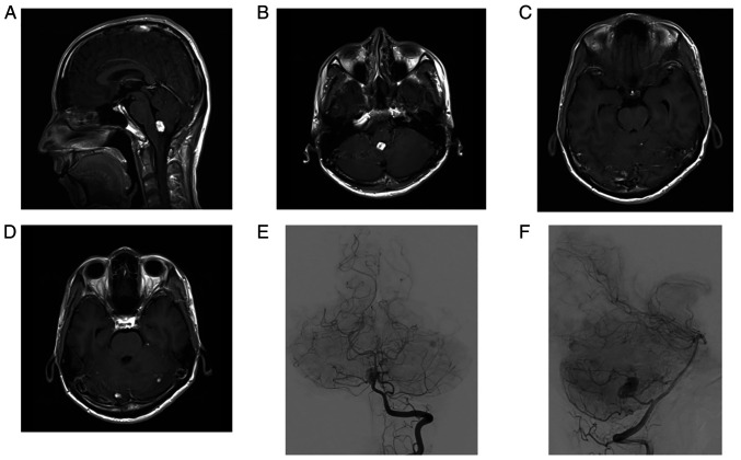 Hemangioblastoma of the medulla oblongata that caused isolated fourth ventricle after stereotactic radiosurgery: A case report.