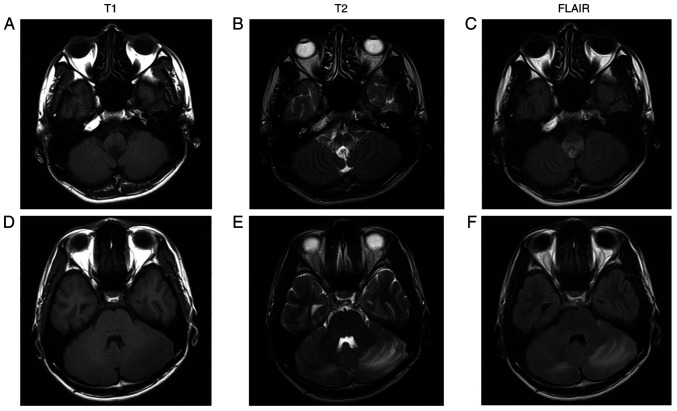 Hemangioblastoma of the medulla oblongata that caused isolated fourth ventricle after stereotactic radiosurgery: A case report.