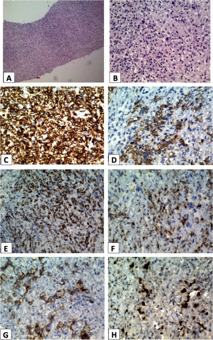 Mediastinal gray zone lymphoma in a pregnant woman presenting with cardiac tamponade.