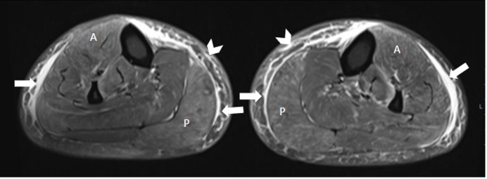 Diagnosis and imaging in COVID-19 induced myositis.