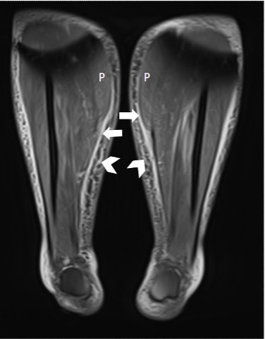 Diagnosis and imaging in COVID-19 induced myositis.