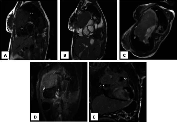 Mediastinal gray zone lymphoma in a pregnant woman presenting with cardiac tamponade.