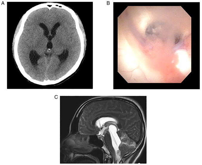 Hemangioblastoma of the medulla oblongata that caused isolated fourth ventricle after stereotactic radiosurgery: A case report.