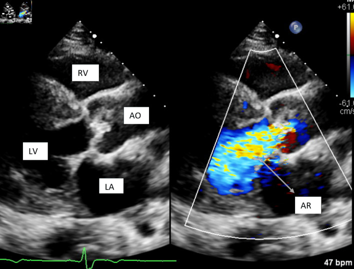 A Rare Case of Congestive Heart Failure due to Isolated Aortic Valve Disease in a Middle-Aged Man Secondary to Rheumatic Fever.