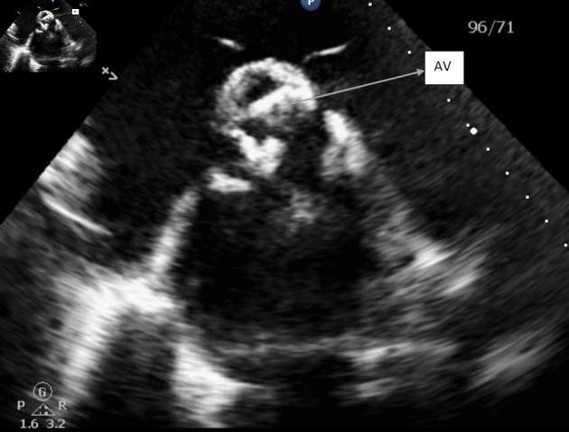 A Rare Case of Congestive Heart Failure due to Isolated Aortic Valve Disease in a Middle-Aged Man Secondary to Rheumatic Fever.