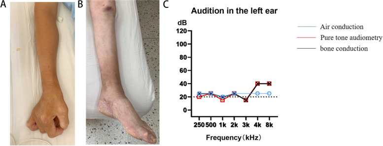 Whole-exome sequencing detected a novel AIFM1 variant in a Han-Chinese family with Cowchock syndrome.