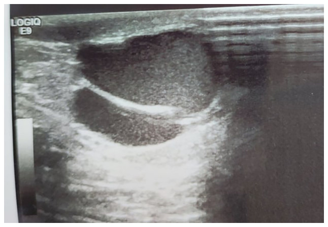 Para‑testicular arteriovenous malformation: A case report and mini‑review of the literature.