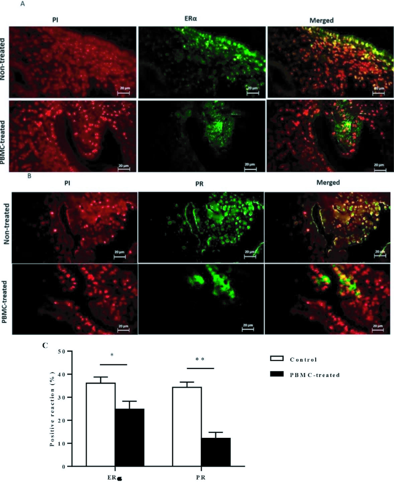 Intrauterine administration of autologous peripheral blood mononuclear cells regulates the endometrium estrogen and progesterone receptor expression: An RCT.