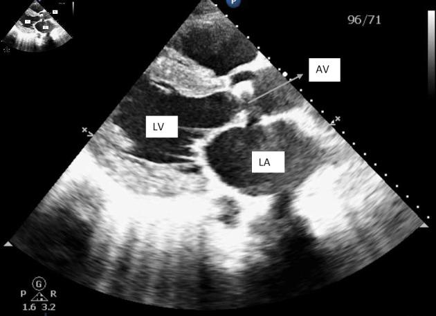 A Rare Case of Congestive Heart Failure due to Isolated Aortic Valve Disease in a Middle-Aged Man Secondary to Rheumatic Fever.