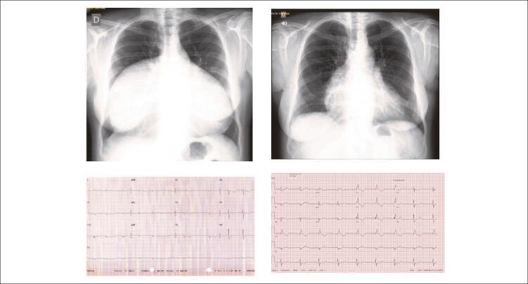 Isolated Aneurysmal Dilatation of the Right Atrium, with Surgical Resolution, in a 53-Year-Old Adult.