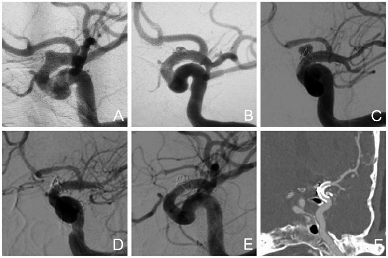 Willis covered stent in the treatment of a recurrent blood blister-like aneurysm after pipeline implementation: A case report