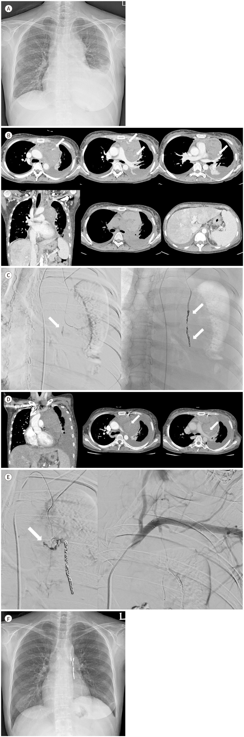 Spontaneous Rupture of the Internal Thoracic Artery Causing a Mediastinal Hematoma in a Patient with Alcoholic Liver Cirrhosis: A Case Report.