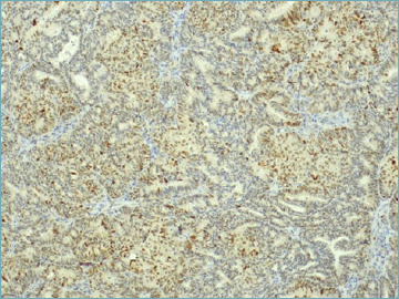 POLE exonuclease domain mutations in endometrial carcinoma: a case report.