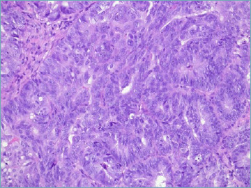 POLE exonuclease domain mutations in endometrial carcinoma: a case report.