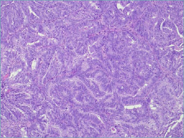 POLE exonuclease domain mutations in endometrial carcinoma: a case report.