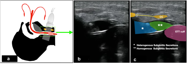 Airway ultrasound to detect subglottic secretion above endotracheal tube cuff.