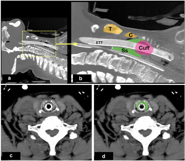 Airway ultrasound to detect subglottic secretion above endotracheal tube cuff.