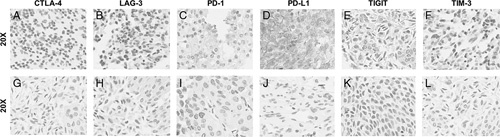 Immune Co-inhibitory Receptors CTLA-4, PD-1, TIGIT, LAG-3, and TIM-3 in Upper Tract Urothelial Carcinomas: A Large Cohort Study.