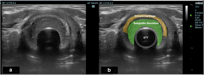 Airway ultrasound to detect subglottic secretion above endotracheal tube cuff.