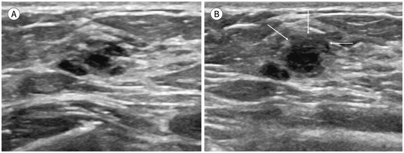 Clustered Microcysts Detected on Breast US in Asymptomatic Women.