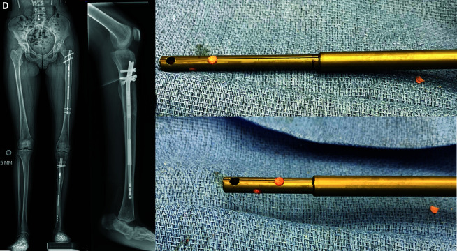 Re-use of Motorised Intramedullary Limb Lengthening Nails.