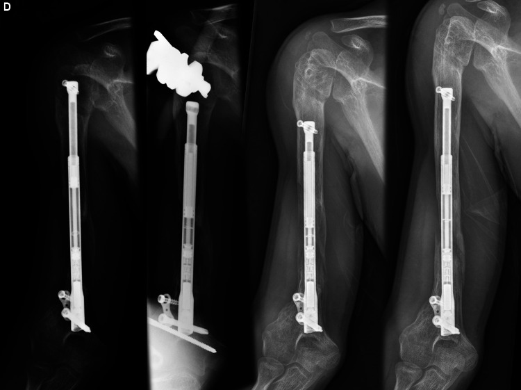 Re-use of Motorised Intramedullary Limb Lengthening Nails.