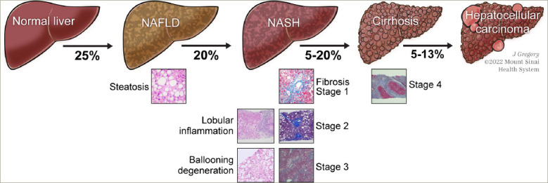 Resmetirom: An Orally Administered, Smallmolecule, Liver-directed, β-selective THR Agonist for the Treatment of Non-alcoholic Fatty Liver Disease and Non-alcoholic Steatohepatitis.