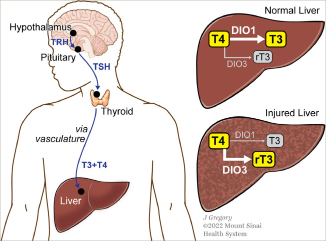 Resmetirom: An Orally Administered, Smallmolecule, Liver-directed, β-selective THR Agonist for the Treatment of Non-alcoholic Fatty Liver Disease and Non-alcoholic Steatohepatitis.