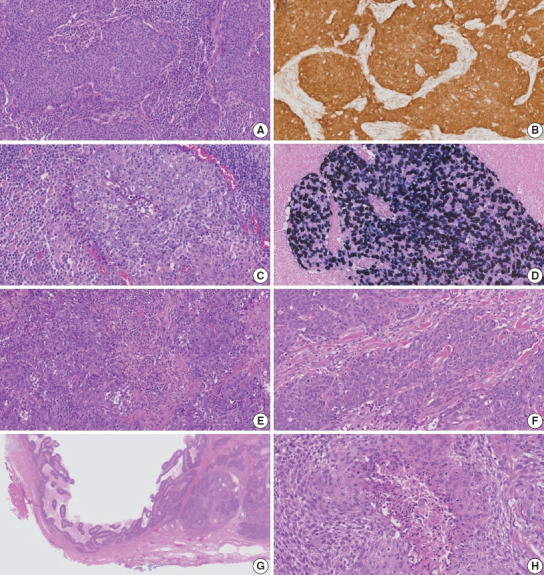 Clinicopathologic characterization of cervical metastasis from an unknown primary tumor: a multicenter study in Korea.